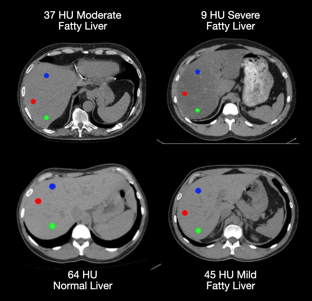 fatty liver and normal liver